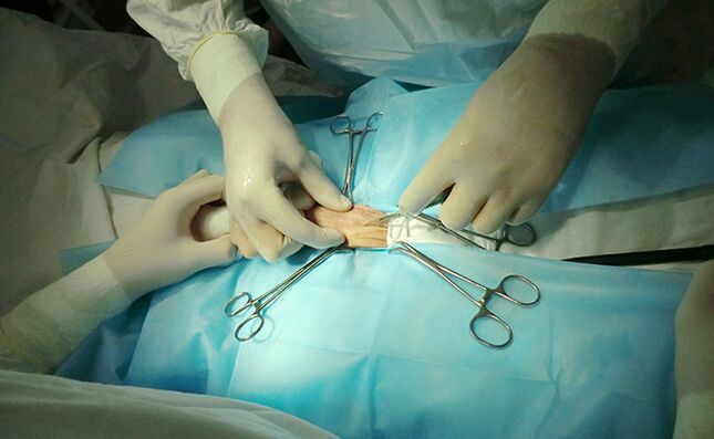 A cirurxía do órgano reprodutor axudará a aumentar o seu tamaño